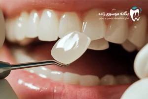 اصلاح لبخند با کامپوزیت چیست؟