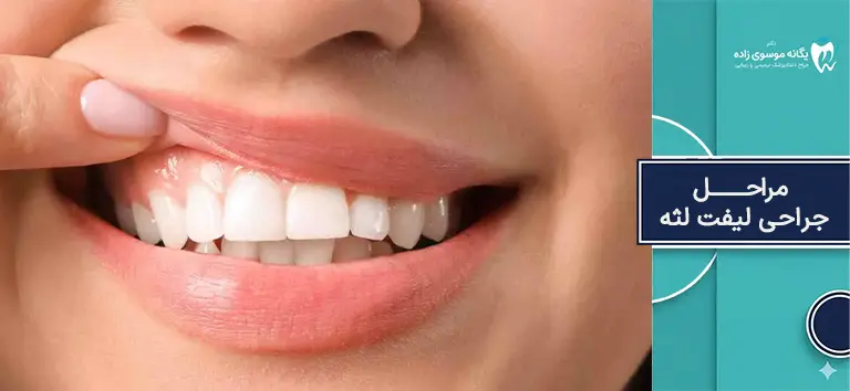 مراحل جراحی لیفت لثه چگونه است؟