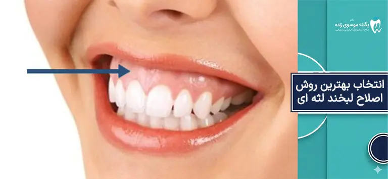 بهترین روش اصلاح لبخند لثه ای 
