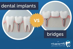 تفاوت ایمپلنت دندان با بریج دندان چیست؟