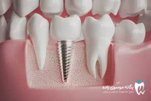 سن مناسب برای ایمپلنت دندان