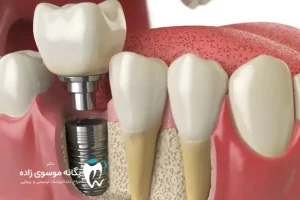 تفاوت ایمپلنت دیجیتال با معمولی چیست؟