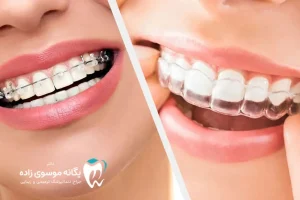 تفاوت کامپوزیت و ارتودنسی: کدام بهتره است؟