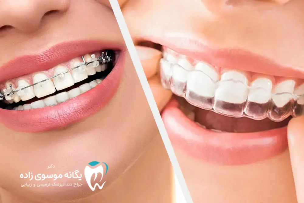 تفاوت کامپوزیت و ارتودنسی: کدام بهتره است؟