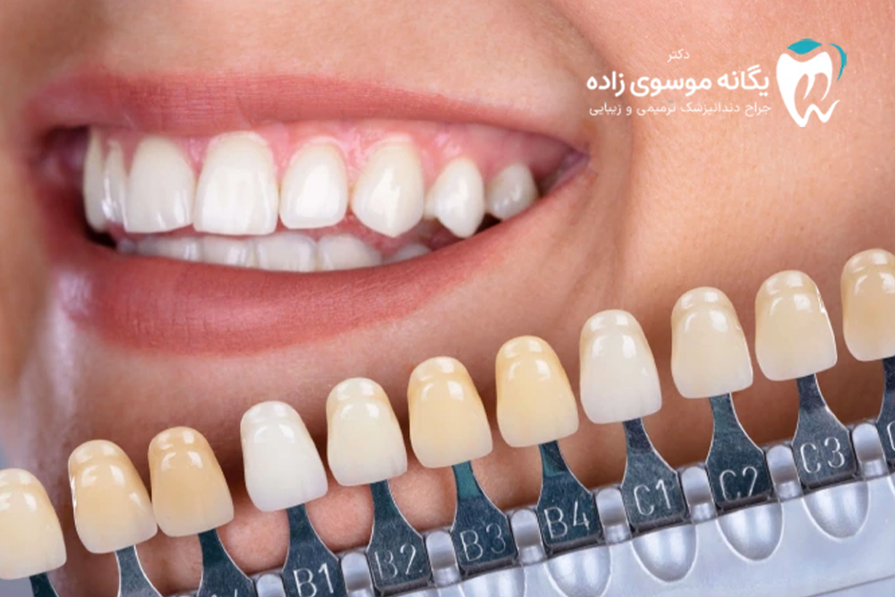 لمینت بدون تراش چیست