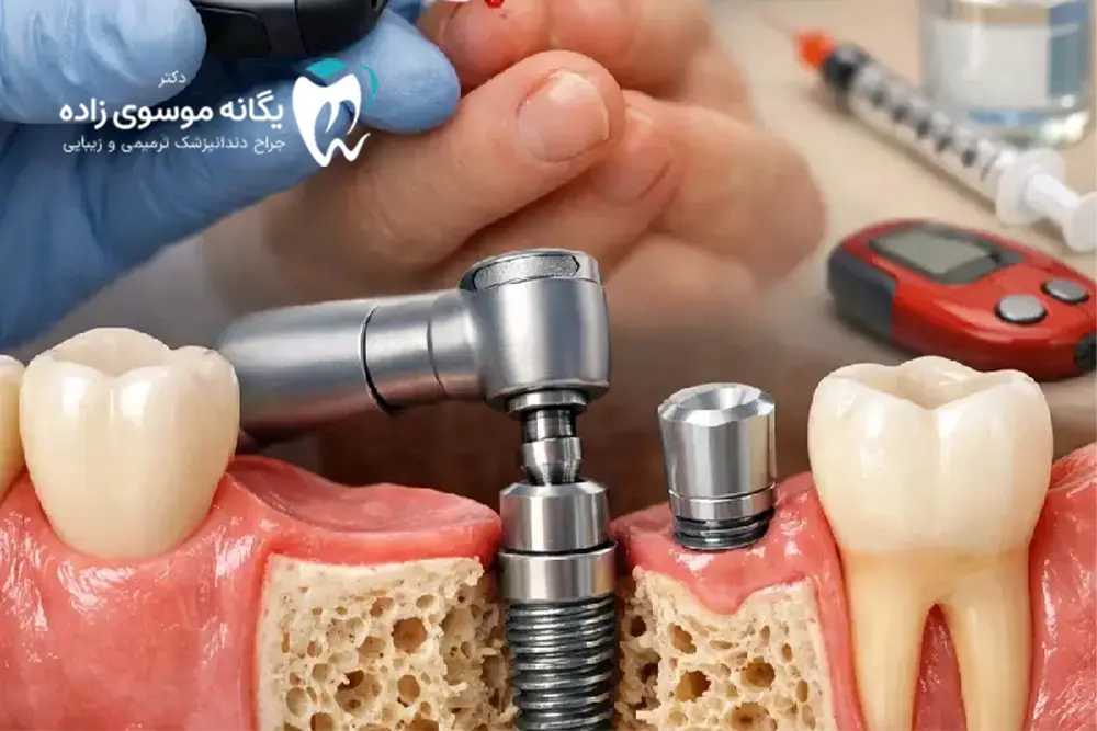 ایمپلنت برای افراد دیابتی