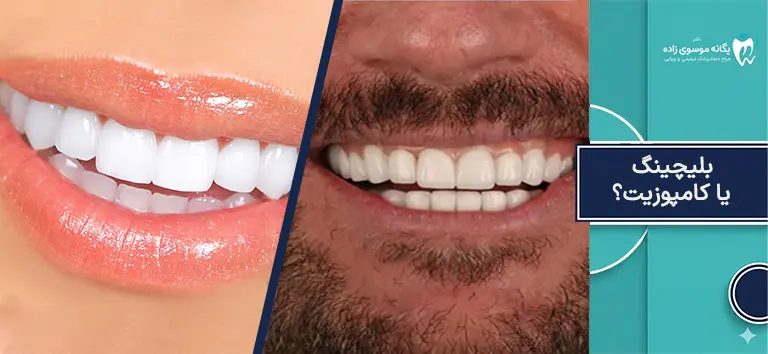 بلیچینگ یا کامپوزیت؟