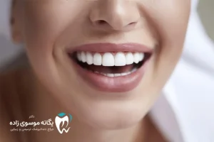 بلیچینگ یا کامپوزیت؟
