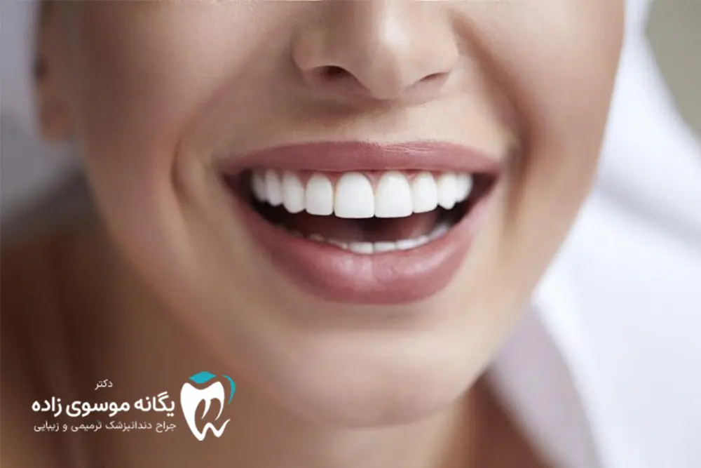 بلیچینگ یا کامپوزیت؟
