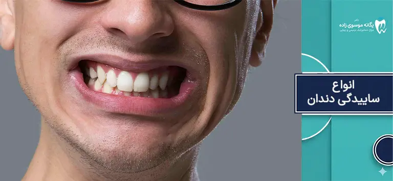 انواع ساییدگی دندان چیست؟
