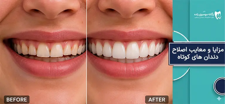 مزایا و معایب اصلاح دندان های کوتاه 