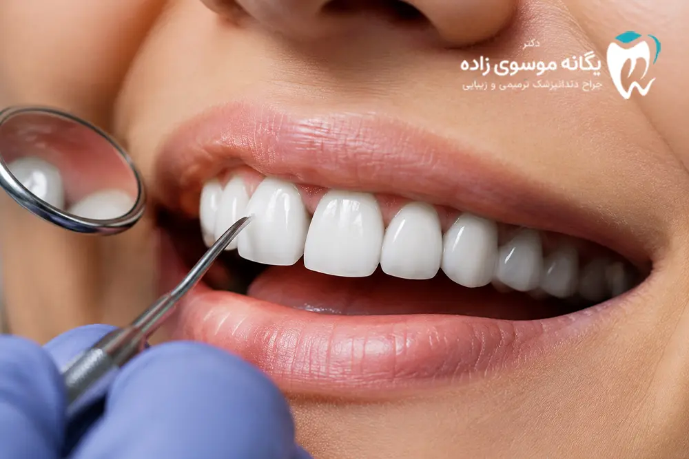 لمینت دندان در مشهد