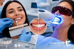 لمینت یا بلیچینگ دندان؟