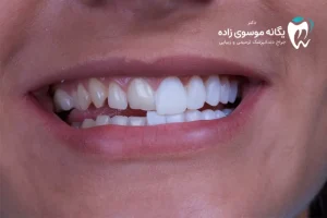 لومینیرز دندان