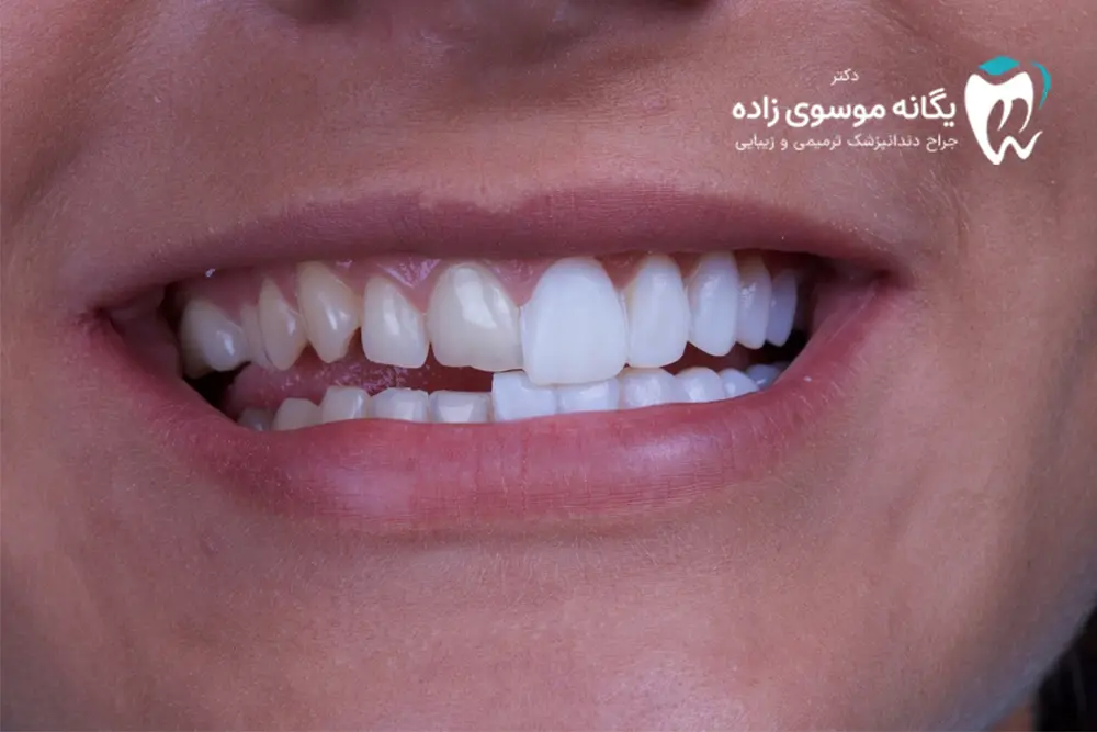 لومینیرز دندان