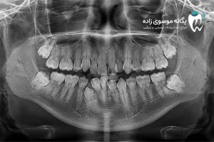 دندان نهفته